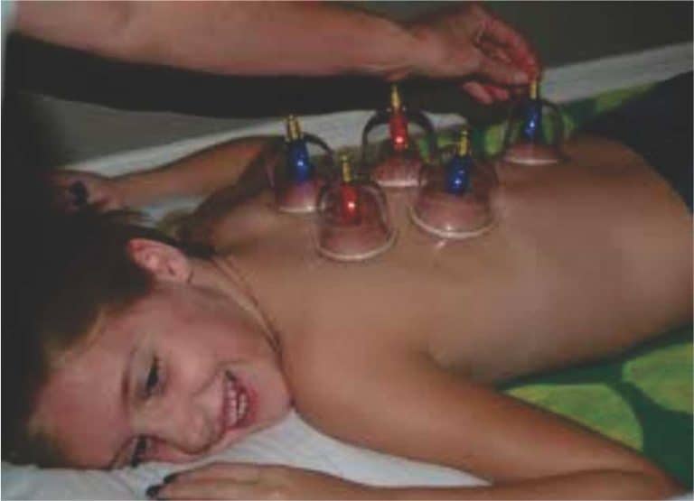 VACUUM CUPPING SET OF 6 KANGZHU